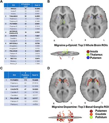 Classifying migraine using PET compressive big data analytics of brain’s μ-opioid and D2/D3 dopamine neurotransmission